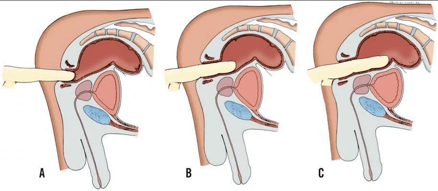 Finger's rectal examination